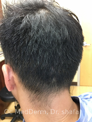 After Alopecia Treatment In Irvine, CA