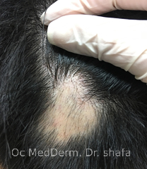 After One Month Of Treatment