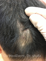 After Second Month Of Treatment