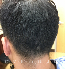 After Few Month Of Alopecia Treatment