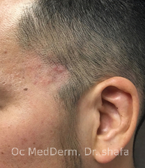 New Patch of hairloss at side hairline