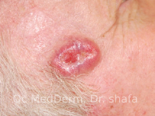 Basal cell carcinoma Non-melanoma Skin Cancer In Irvine, CA