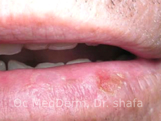 Squamous cell carcinoma Non-melanoma Skin Cancer In Irvine, CA